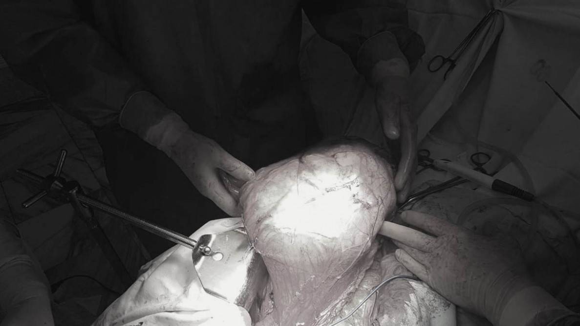 Красноярские хирурги удалили опухоль весом 6 килограммов