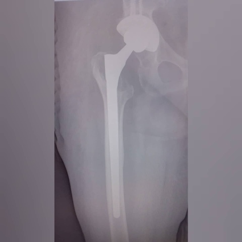 Протез.jpg Протез.jpg