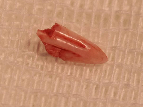 Из пальца красноярки извлекли кошачий клык. Фото: https://www.instagram.com/dr.keosyan/